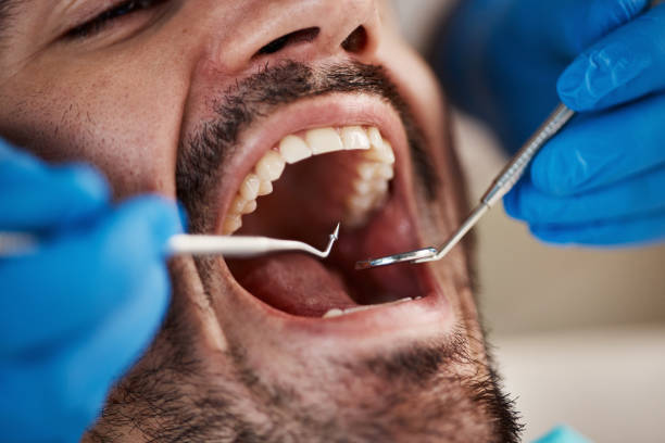Best Dentist for Tooth Abscess  in La Villa, TX